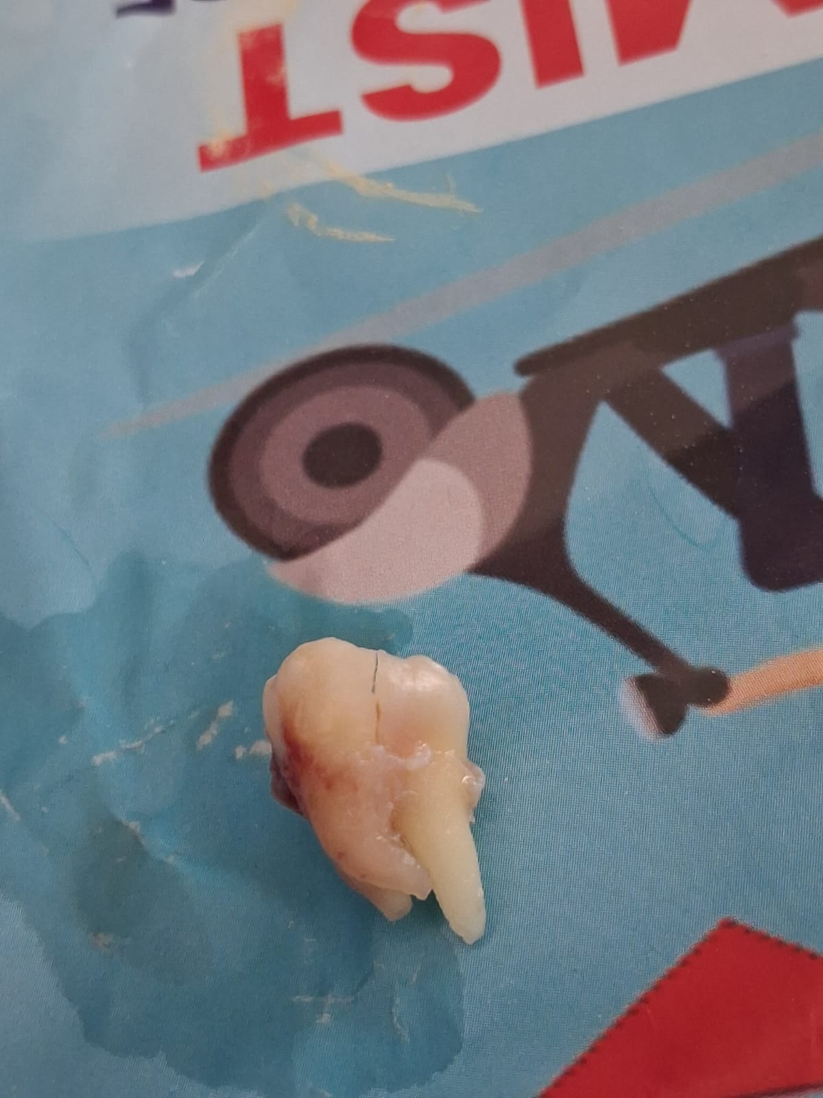 Tooth Extraction
