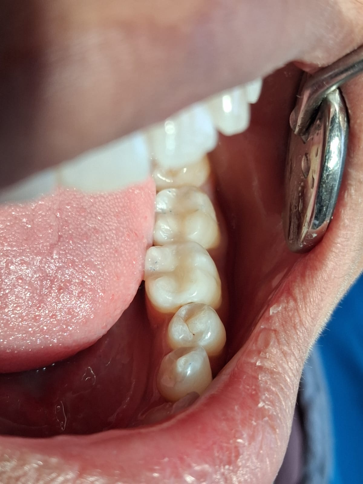 After crown restoration