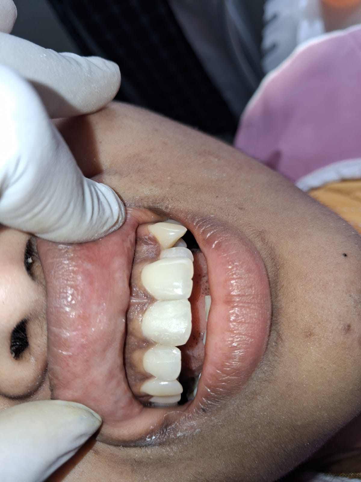 After implant treatment