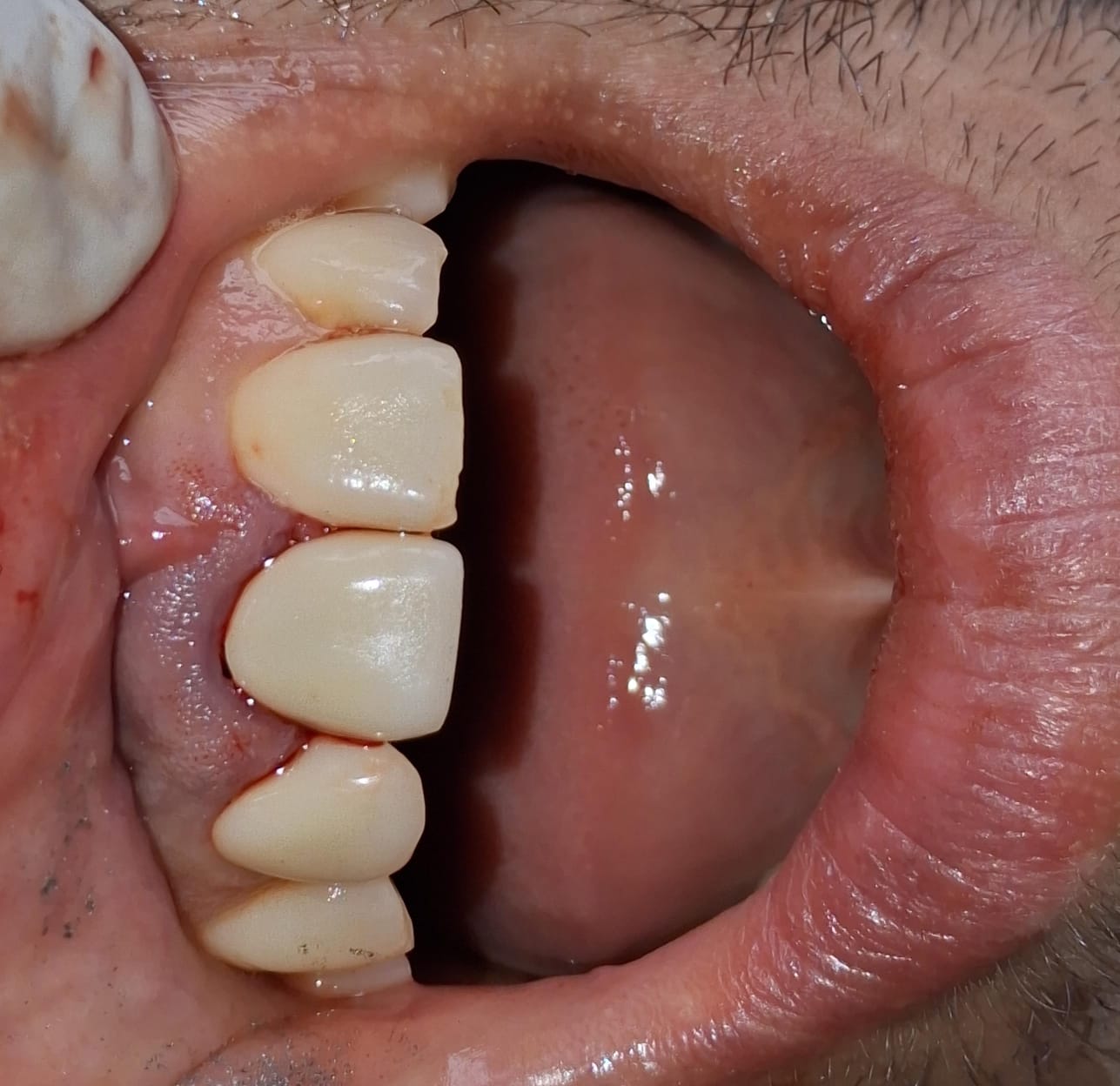 Whitening results from dental treatment