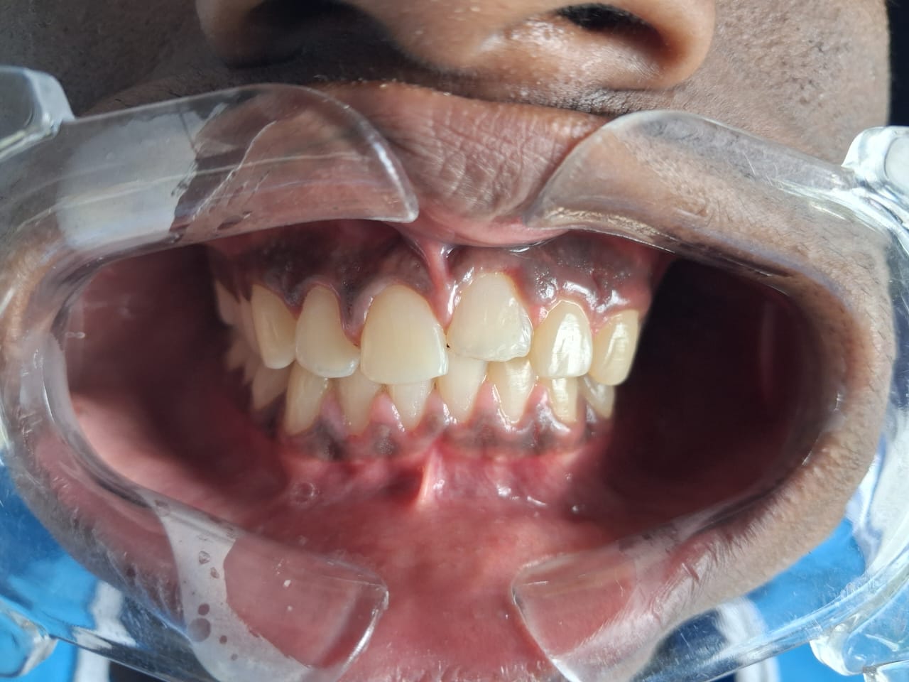 Child dental care smile